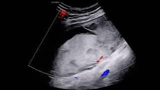 Micro-Vascular Imaging in Placental Infarction – Video S1 [440522]