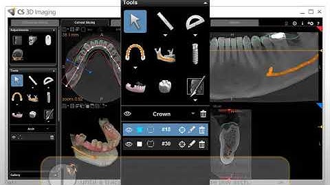 CS 3D Imaging: Prosthetic-Driven Implant Planning Workflow Recorded Class