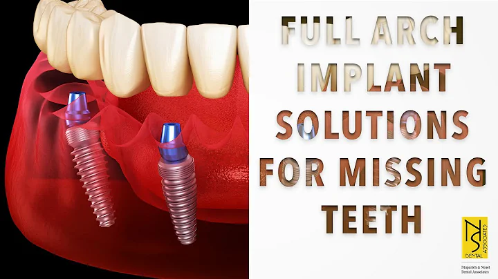 A Permanent Solution to Replacing Bad Teeth