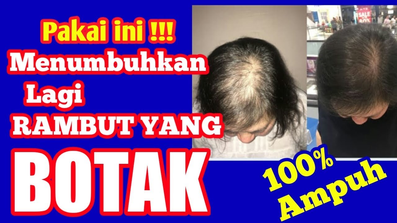 Cara menumbuhkan rambut botak dengan cepat || Bunda Hamla