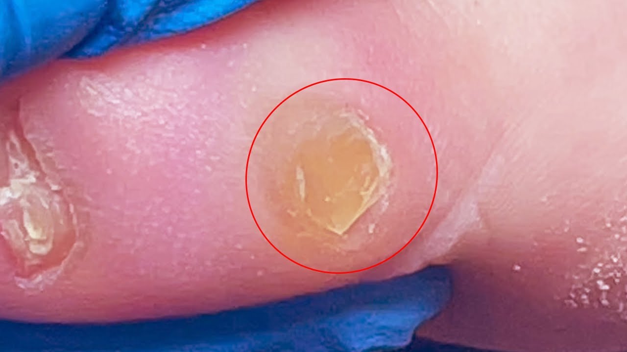 Toe Oversized Callus Removal YouTube