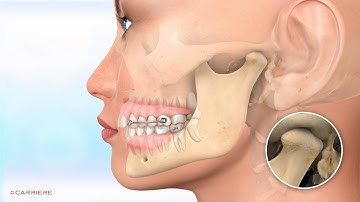 Carriere Class II distalization