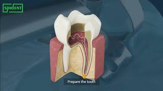 [SPIDENT] Root Canal Treatment with SPIDENT products