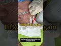 Endolift I Double Chin Reduction I Non cutting or injection. #doublechinremoval #endolift #lifting