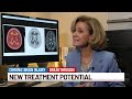 New Brain Scan Could Finally Detect CTE in Living Patients