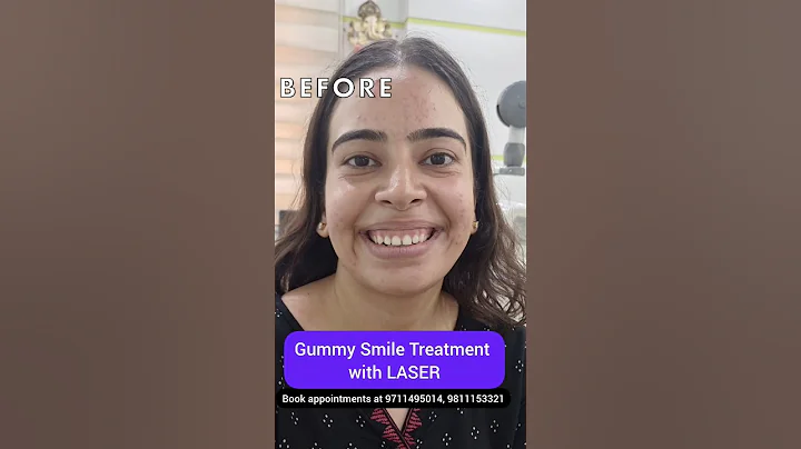 Gummy Smile Treatment with LASER; Dr. Srishti Bhatia #laser #teeth #smilemakeover