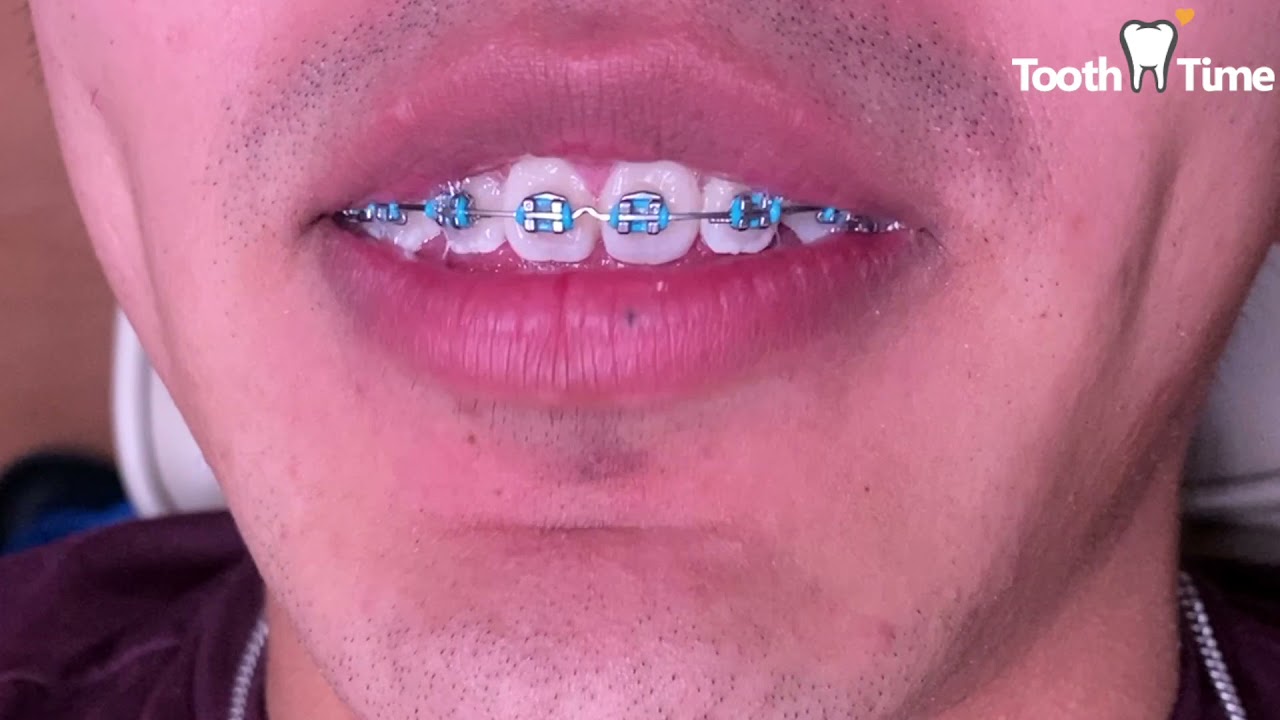 Braces Checkups 7 months with RPE and Tongue Crib Kobayashi hooks