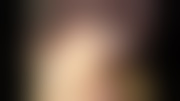 Fundal GIST Laparoscopic Excision