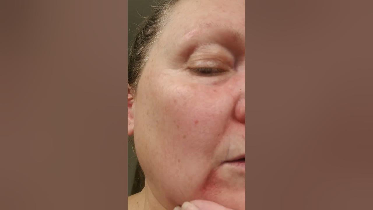 Day 12 fluorouracil 5 treatment basal cell carcinoma actinic keratosis