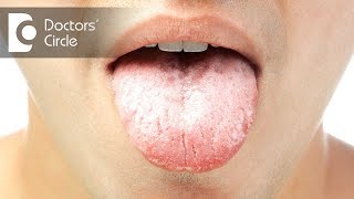 Causes and symptoms of oral thrush - Dr. Jayaprakash Ittigi