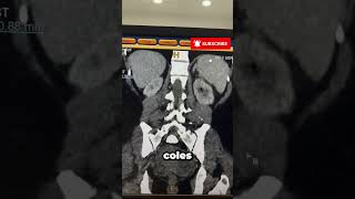Emphysematous Pyelonephritis on CT Scan