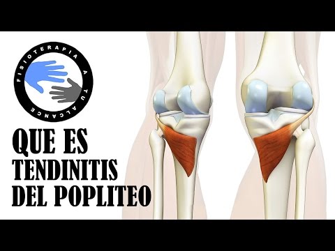 Tendinitis poplitea, que