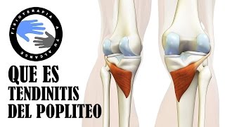 Nervioso daño Cómo saber en tienes la rodilla si