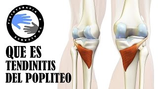 Tendinitis poplitea, que es y porque se produce el dolor detras de la rodilla