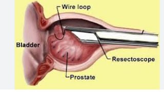 LUT ENDOSCOPES 2 (Rescectoscope equipments)