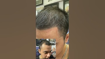 Trán chữ m, hói trán cao , tóc thưa xem hết video nhé #xămtóc  tóc hói nam xăm điêu khắc tóc nam