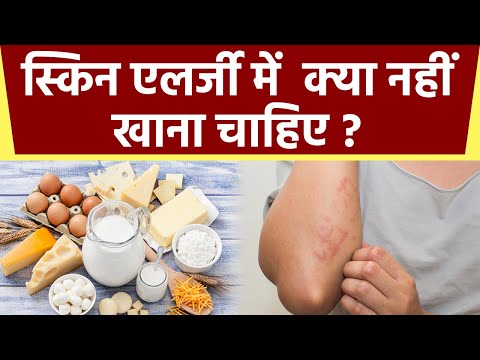 Skin Allergy होने पर नहीं खानी चाहिए ये चीजें वरना...| Boldsky