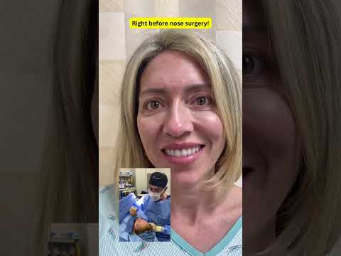 Video thumbnail: Crooked Nose, revision Rhinoplasty! #nosereshape #plasticsurgery #preservationrhinoplasty · Ali Sajjadian