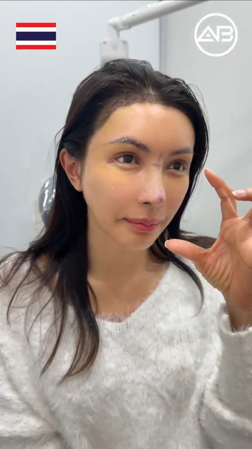 Complete Makeover: Eyes, Nose & Hair Transplant in Just 7 Days! #shorts