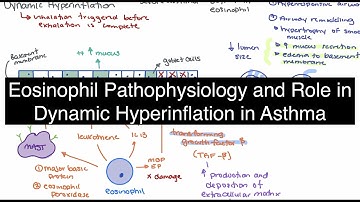 Eosinophil Infiltration and Dynamic Hyperinflation in Asthma