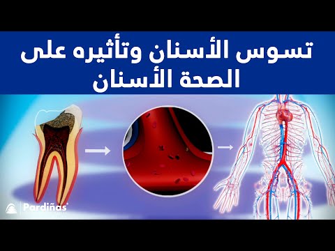 فيديو: هل يمكن أن تشكل البلاك على أسنان الكلب عدوى بكتيرية في الجسم؟