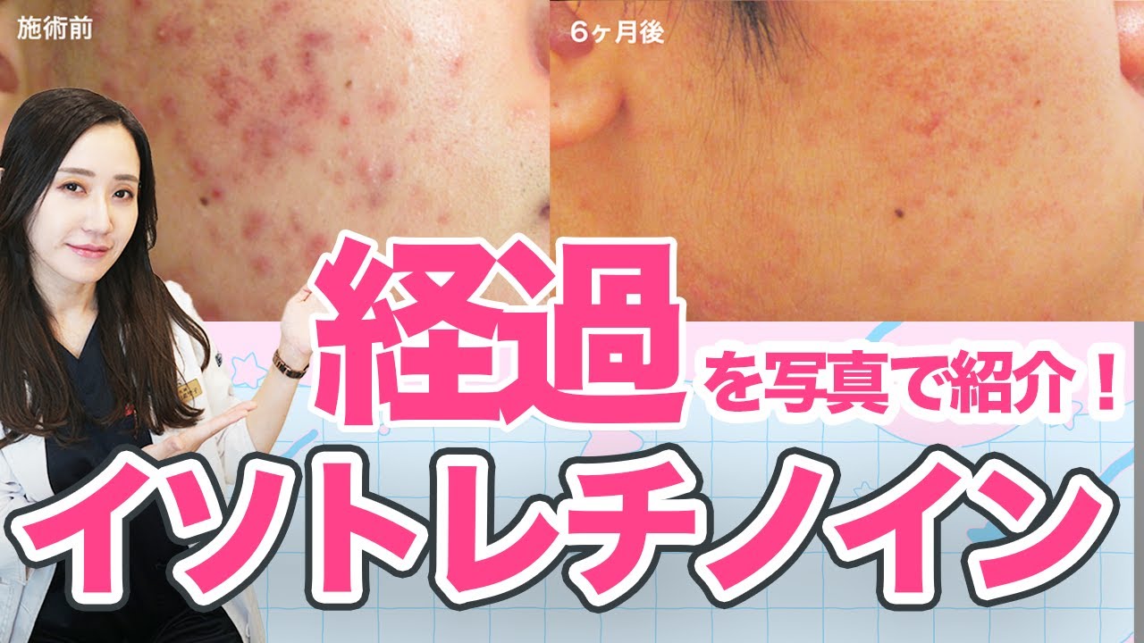 イソトレチノインの経過を写真で解説します【ロアキュタン・アキュテイン】