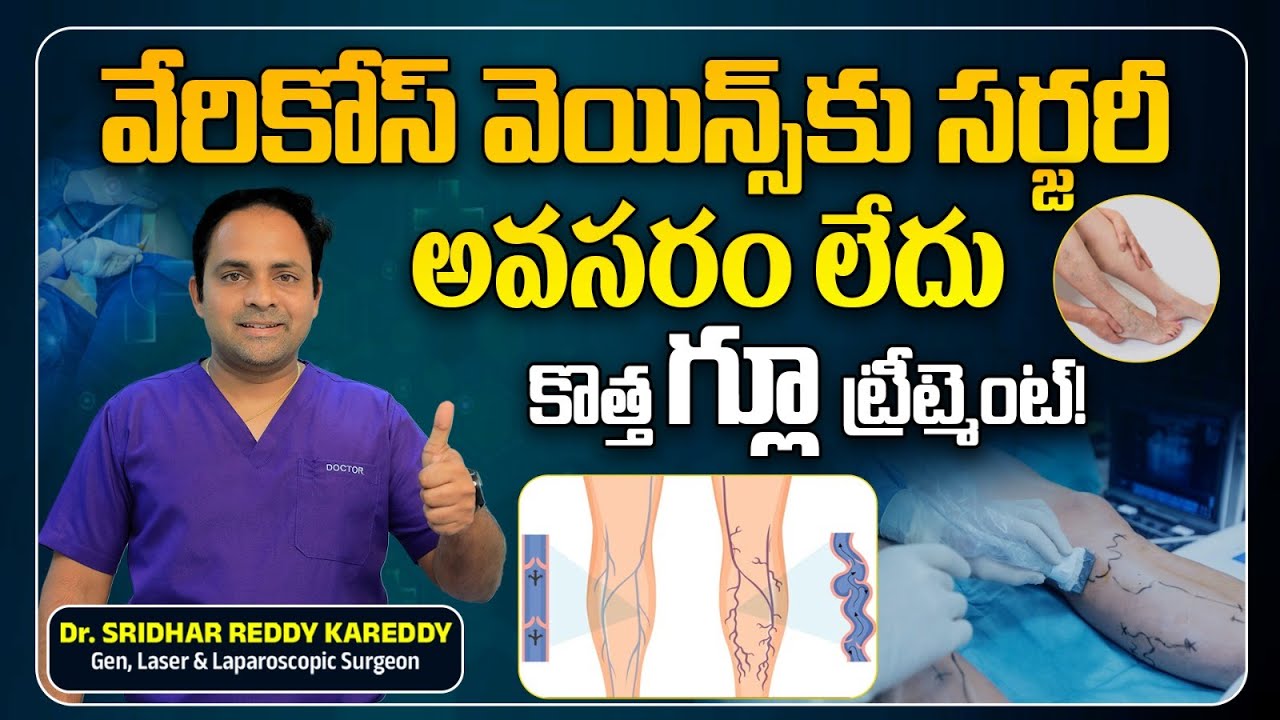 Varicose Vein Telugu | Varicose Vein Glue Treatment | Health Tips In Telugu | Dr Sridhar Reddy