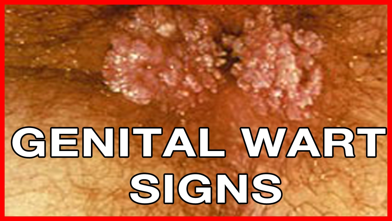 How to Recognize Genital Warts How to Recognize Genital Warts