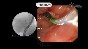 ERCP Procedure Video | Best Gastroenterologist in Bangalore - Dr Dinesh Kini | Sakra World Hospital