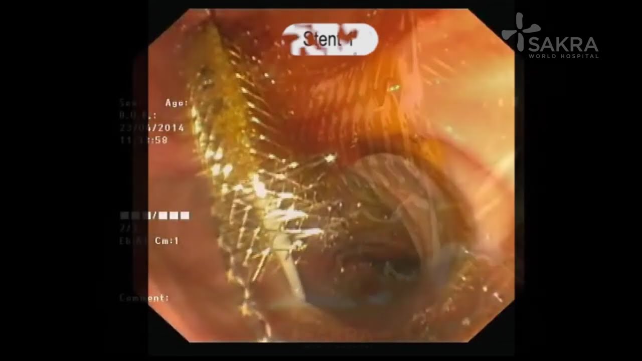 Ercp Procedure Video Best Gastroenterologist In Bangalore Dr Dinesh Kini Sakra World Hospital Youtube