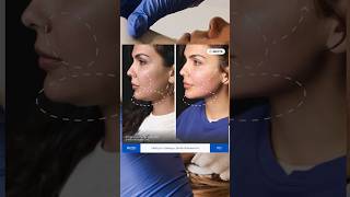 Smas Hifu Facelift From Zemits Our Secret Weapon Against Aging