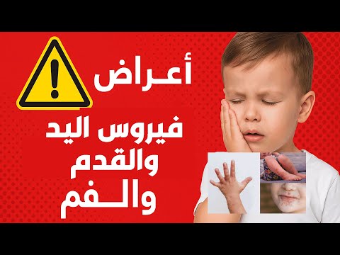 أعراض فيروس اليد والقدم والفم عند الاطفال لازم كل أم تعرفها