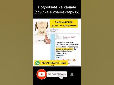 Узел в щитовидке - YouTube