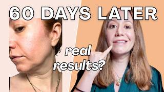 Angel Lift 60 Day Results: Laugh Line Experiment (Nurse Review, No Botox)