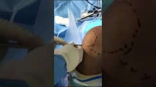 عملية ناظور الركبة العلاجي ورفع جزئي للغضروف الهلالي الانسي المتمزق تمت على يد الدكتور عصام خالد