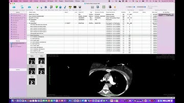 Making exams fully anonymous in PACS *Not for Medical Usage **