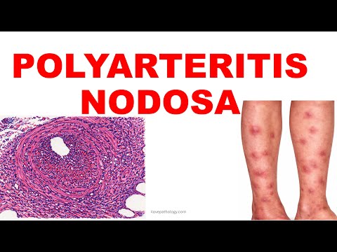 Polyarteritis Nodosa | Pathogenesis And Morphology|  Vasculitis – Part 5