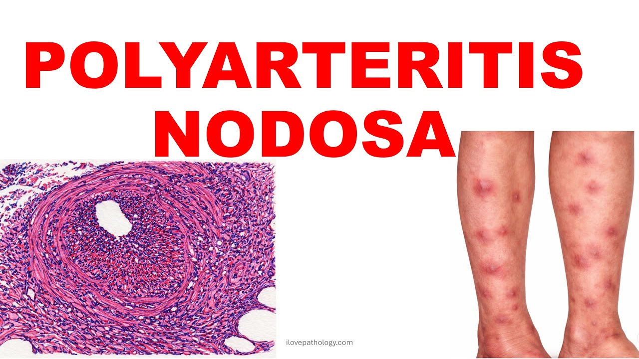 POLYARTERITIS NODOSA | Pathogenesis and Morphology|  Vasculitis – Part 5