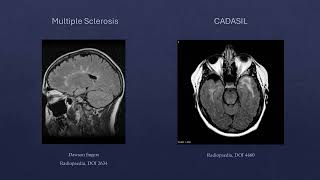 RadExam Study Guide - Neuro Case 3