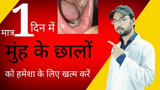 एक दिन में मुंह के छाले गायब । मुंह के छालों (Mouth Ulcers) का घरेलू उपचार | mouth ulcer home remedy