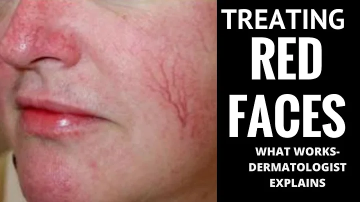How to treat red faces