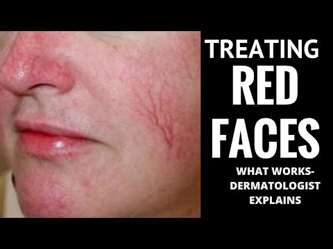 Videó: A Rosacea Fertőző? Olyan Kérdések, Amelyeket Félhet Feltenni