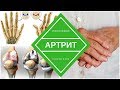 Ревматоидный артрит - причины и виды лечения