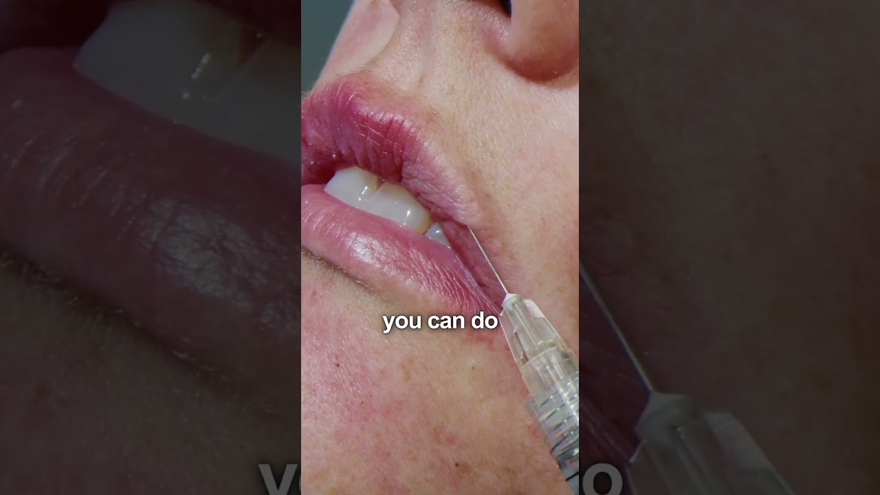 The most important anatomy lip injectors need to know.