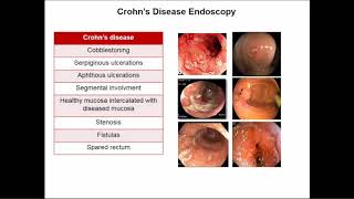 Early Intervention in IBD: From Diagnosis to Disease Modification
