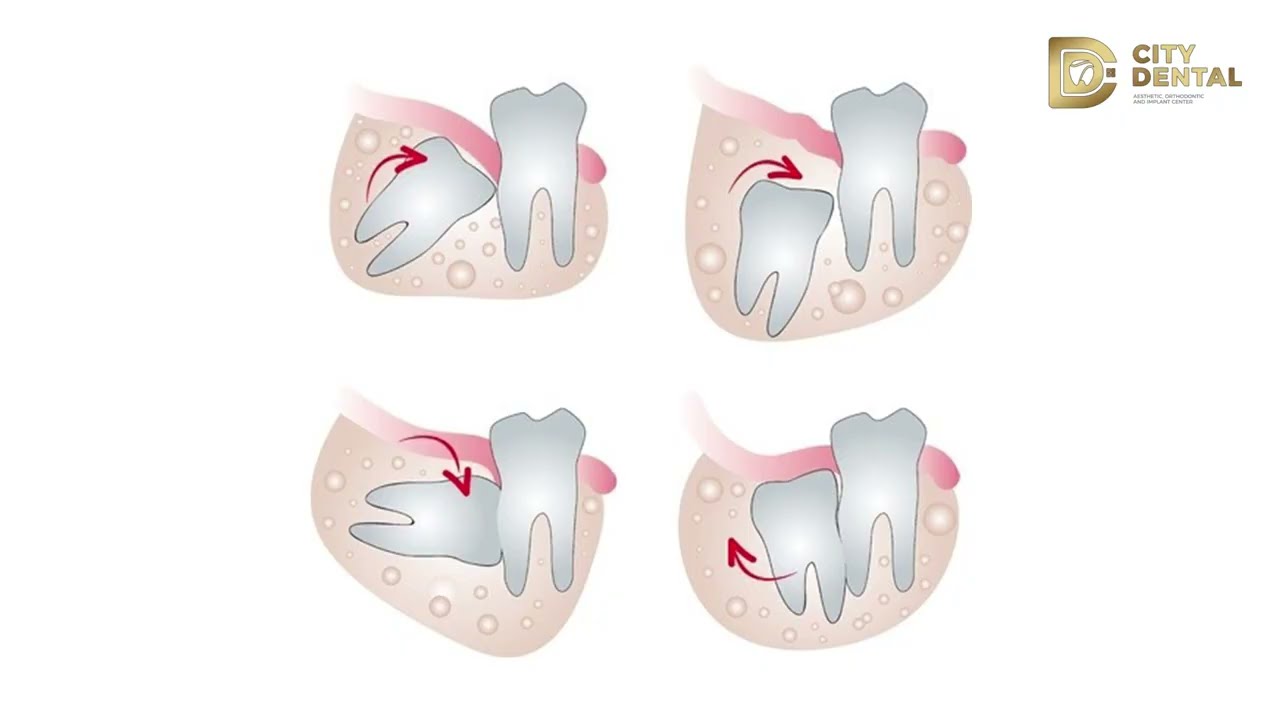 အံဆုံးသွားအကြောင်း သိကောင်းစရာ (All About Wisdom Teeth)