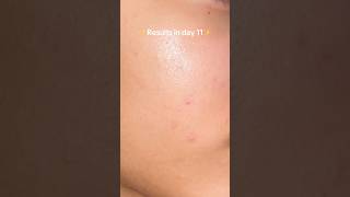 Clearing hormonal acne with Paula’s Choice 2% BHA 😭✨ | Skincare Journey