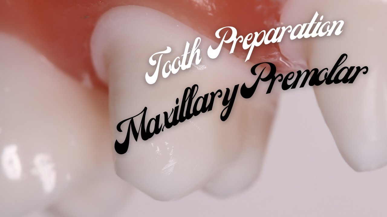 健康・医学 The Tooth Preparation PFM Preparation for #8 Kilgore | Stevenson Dental Solutions