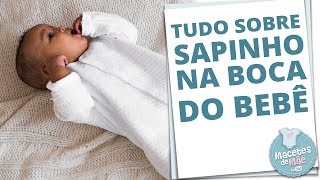 Sapinho Na Boca Do Bebê O Que É E Como Tratar Macetes De Mãe