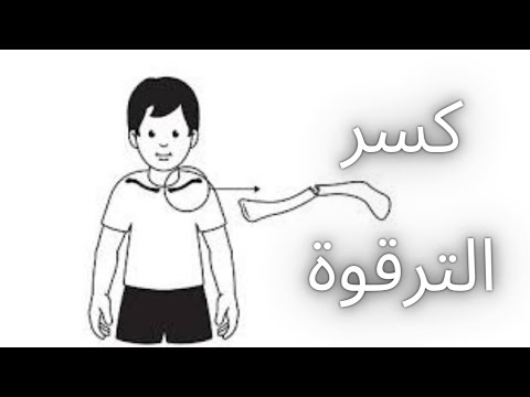 علاج كسر الترقوة في الأطفال أفضل الاستراتيجيات والنصائح    